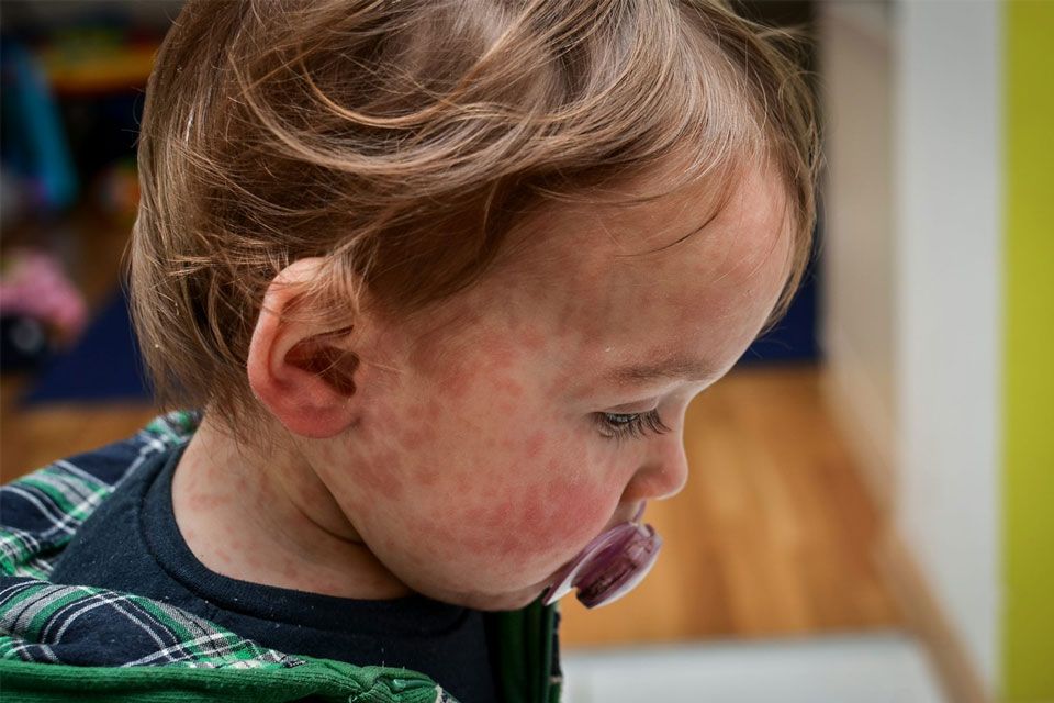 Canada's two-year measles outbreak is officially over, public health agency says
