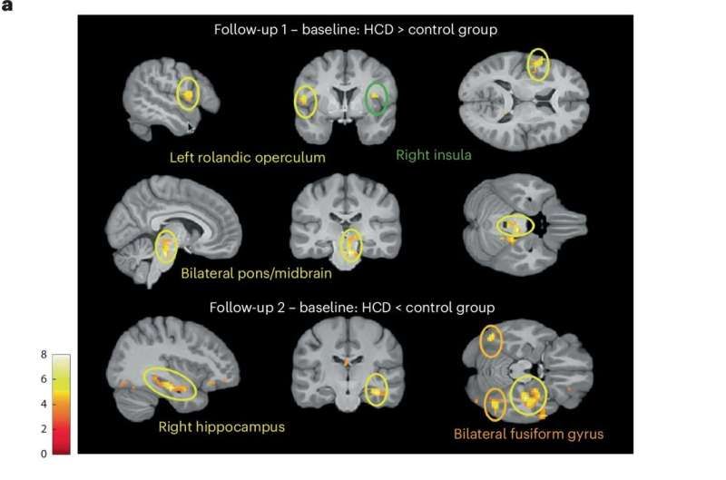 Ultra-processed foods linked to brain changes that could raise stroke, dementia risk